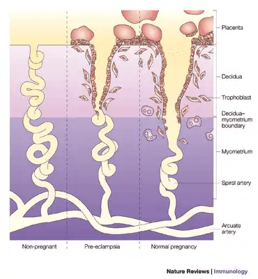 pre-eclampsia pre-eclampsia